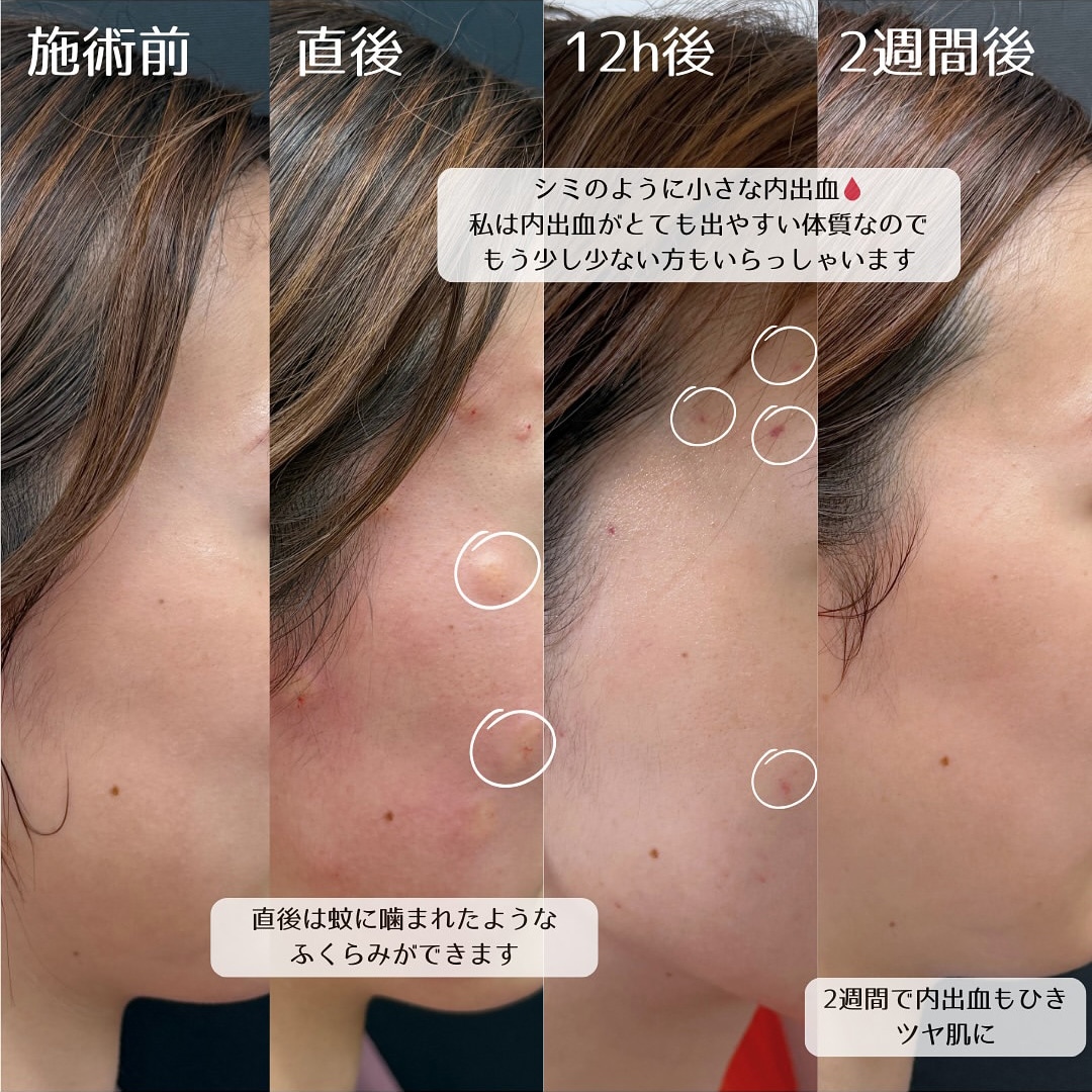 施術後のダウンタイム経過