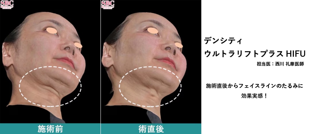 すっきりしたのにたるんでしまった…そのお悩みを解決