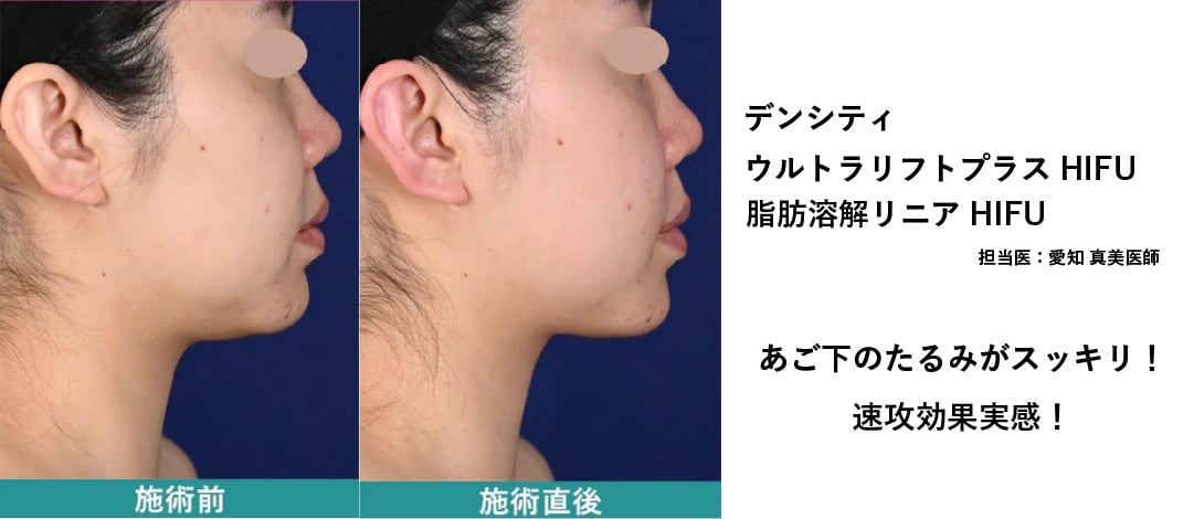 脂肪溶解リニアHIFUをプラスして、手術なしで小顔へ