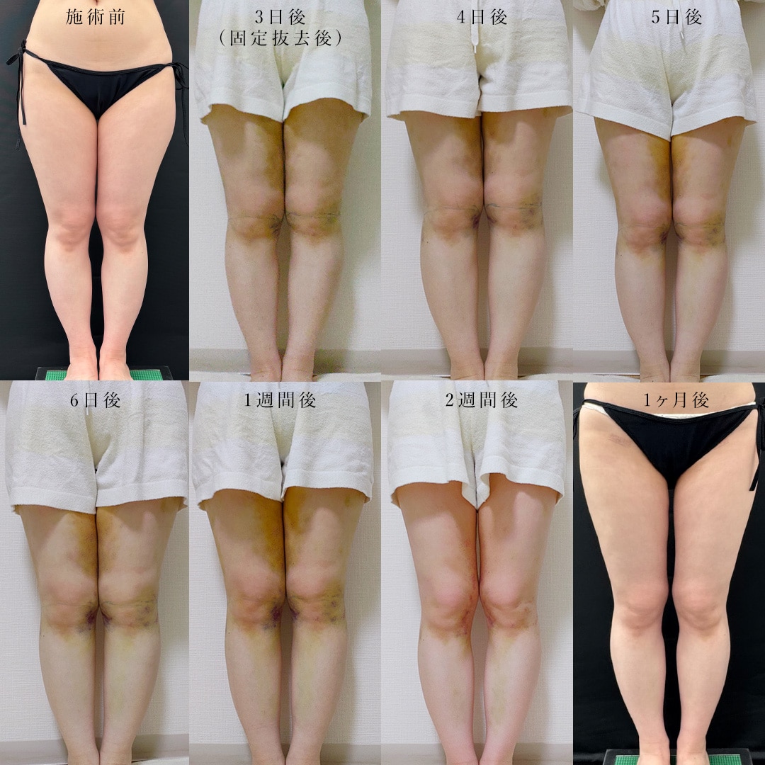 太もも＋お尻＋膝の脂肪吸引の場合