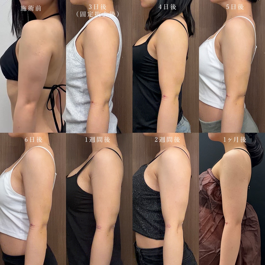 向山院長は、豊富な経験と技術力で、<strong>「腫れ・内出血の少ない脂肪吸引」</strong>を追求しています。