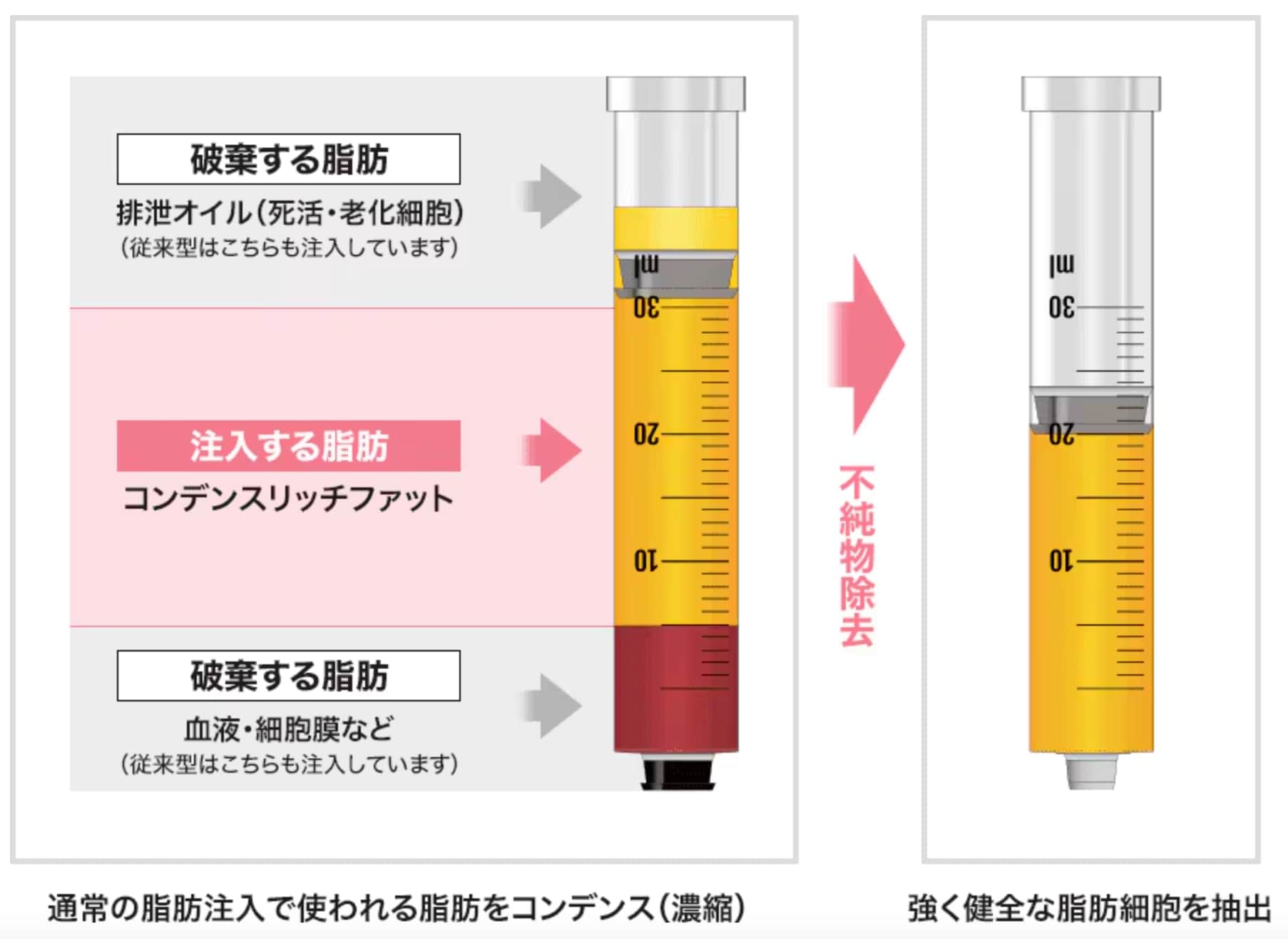 「定着しない?しこりが怖い?」その不安、脂肪吸引の“技術力”が鍵です。