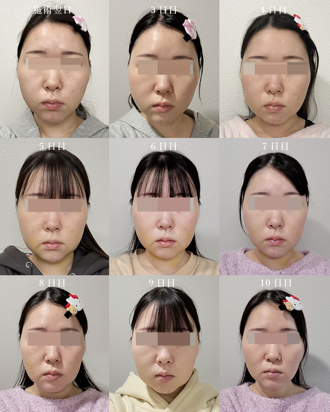 ホホ＋アゴ下＋メーラーファット＋バッカルファット＋シークレットリフト６本