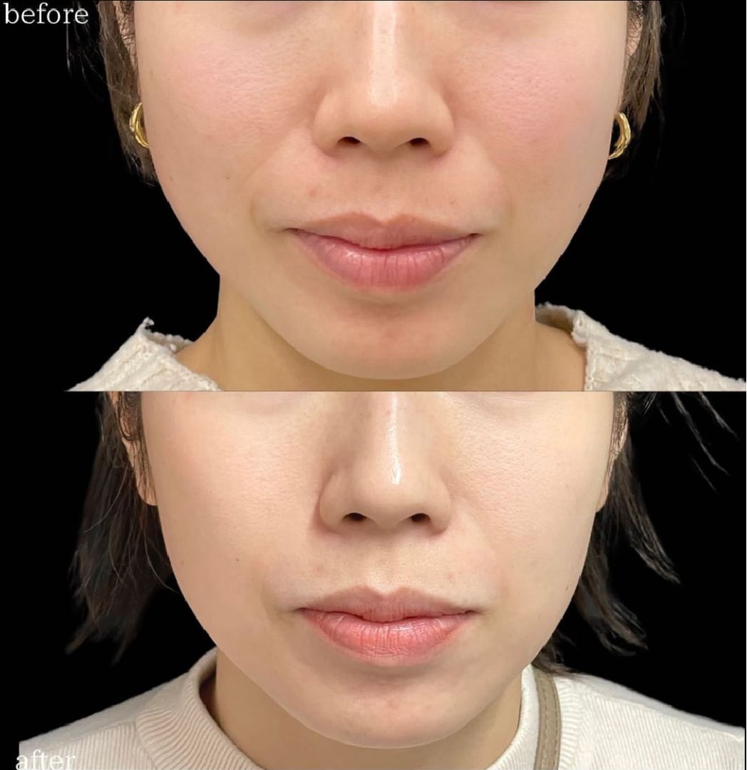 【肌質改善】内側から輝くハリと潤いをチャージ