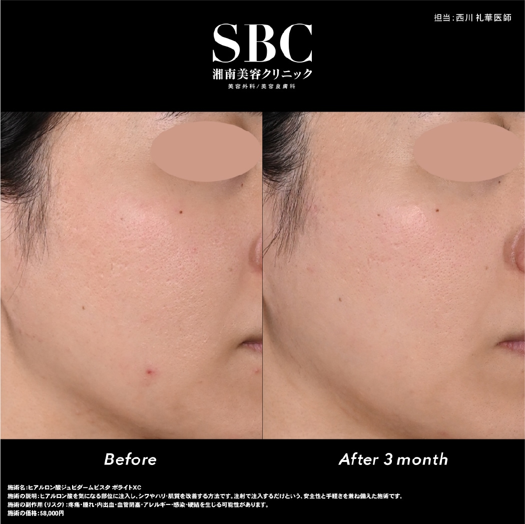 しわ・ほうれい線・たるみ・肌のボリューム改善などの効果が期待。