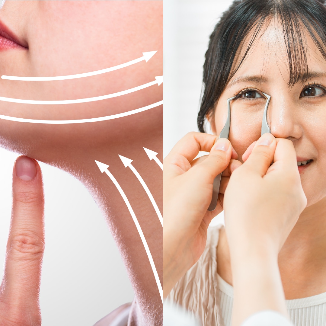 【フェイス】「私、なんか垢抜けた？」顔の脂肪吸引＆埋没法二重術