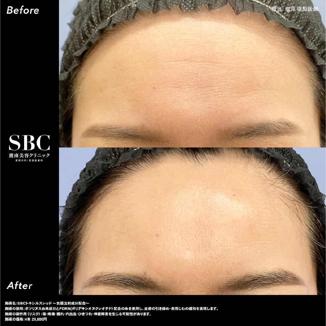 リジュラン＋ボトックス成分を配合した美容針