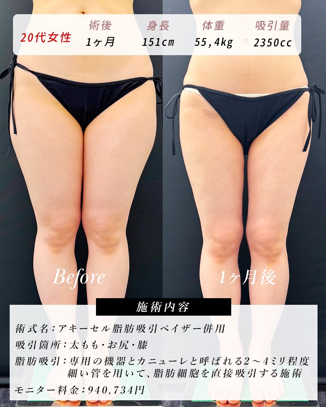20代女性：コンプレックスは、太い下半身