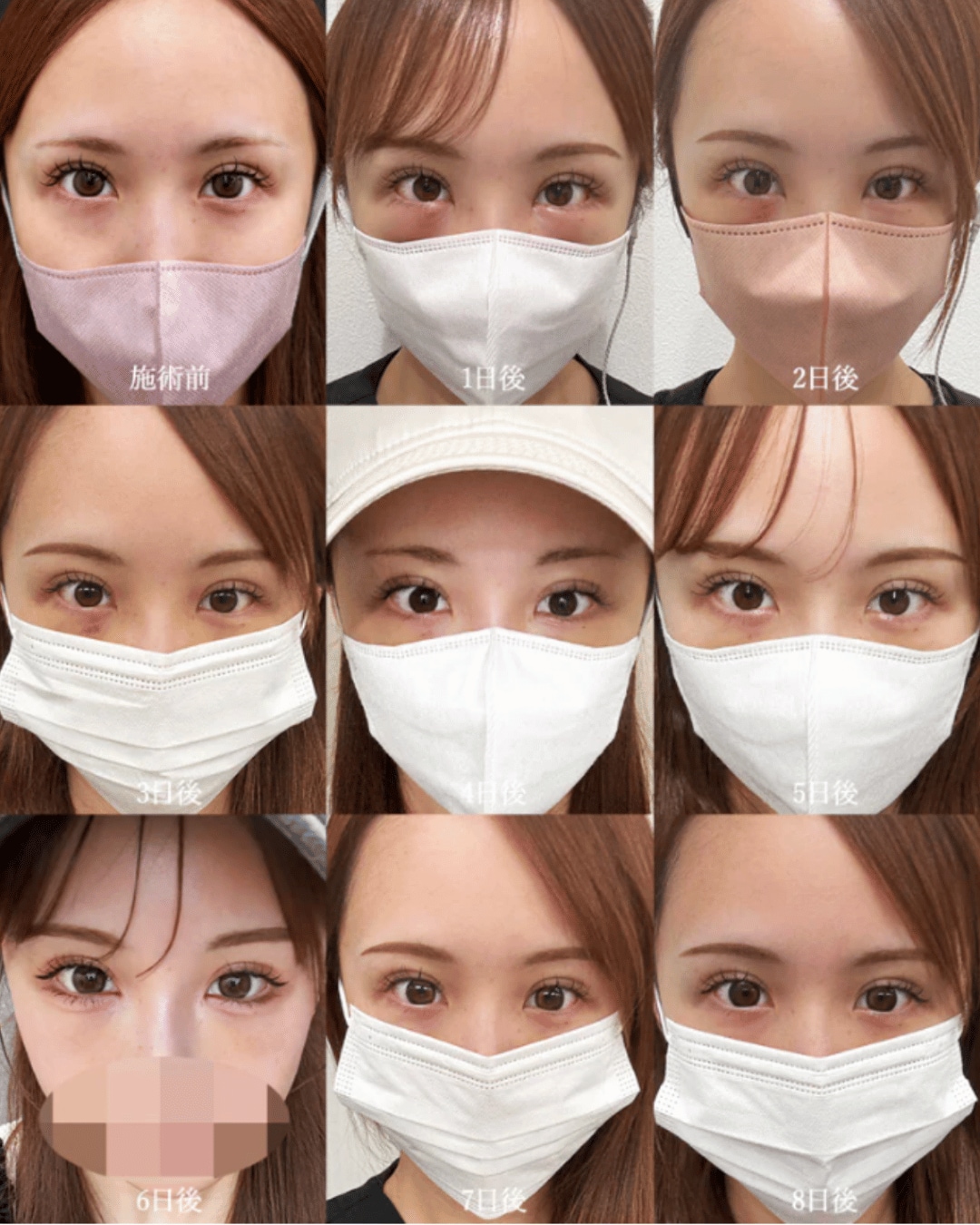 脱脂のダウンタイム経過