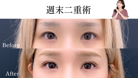 奥二重っぽく見えるお目元にお悩みのお客様