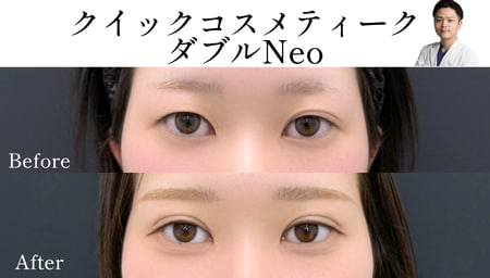 二重の左右差にお悩みのお客様