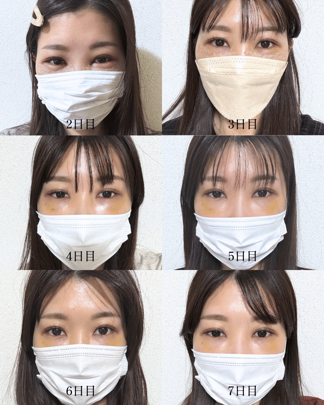 裏ハムラのダウンタイム経過