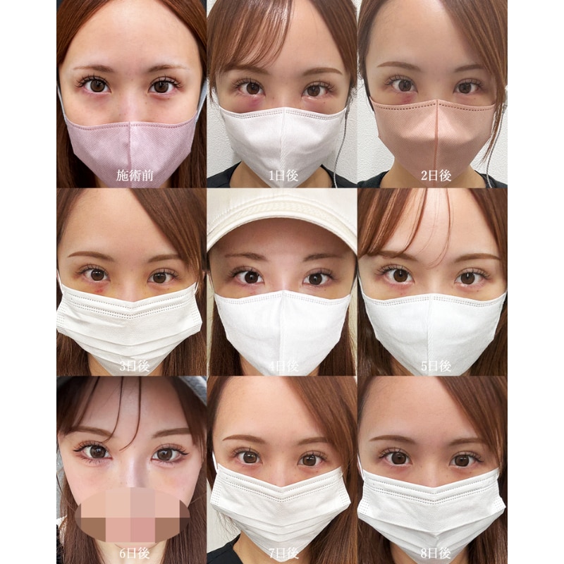 1週間のダウンタイム経過