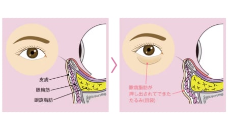 目の下の切らないクマたるみ取り〔脱脂）とは