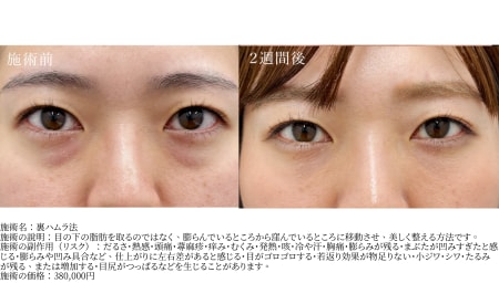 裏ハムラのメリット・デメリット