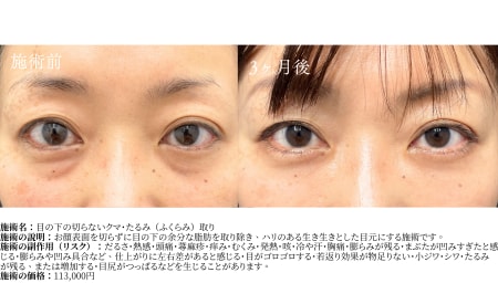 目の下の切らないクマたるみ取り（脱脂）のメリット・デメリット