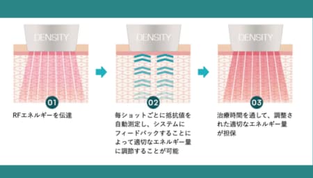 肌の状態を都度確認し、均一なエネルギーを照射