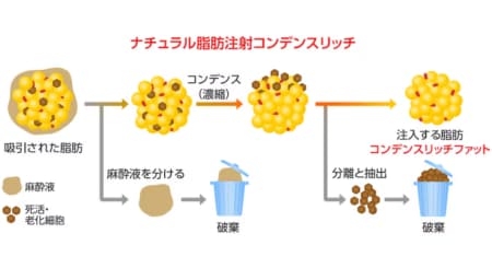 3.脂肪採取 ・ 注入に抵抗がある方