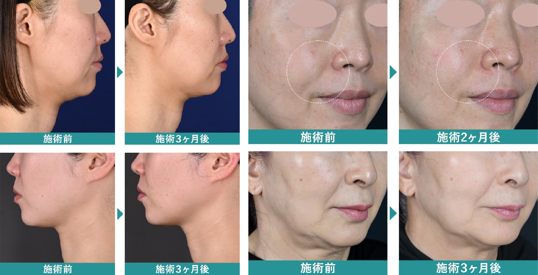 即効引き締め×持続するハリ感で、自分史上最高のフェイスラインへ