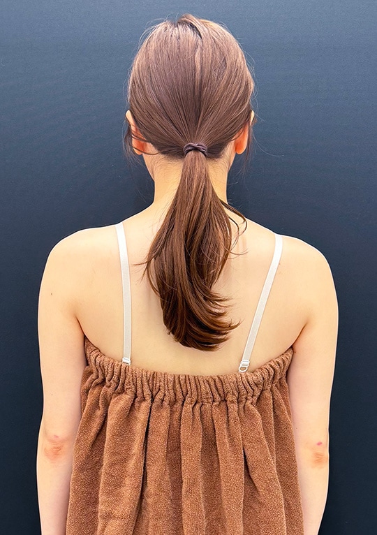 {施術名} {年代}  {性別} の術後の症例写真