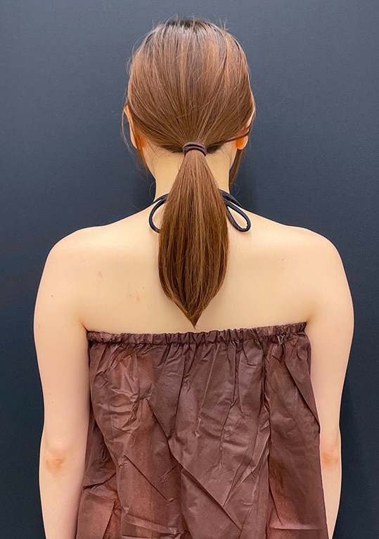 {施術名} {年代}  {性別} の術前の症例写真