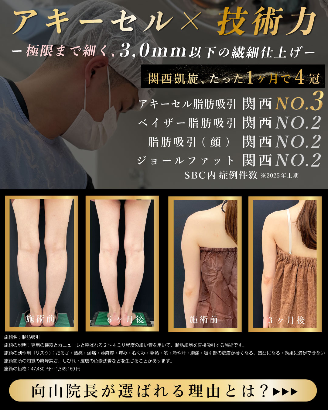 【大阪堺東院】向山院長の脂肪吸引が選ばれる理由