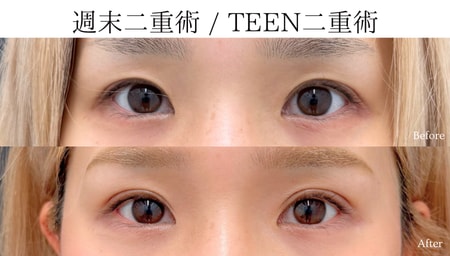 奥二重っぽく見える目元にお悩みのお客様