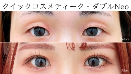 二重のりの使用で瞼のたるみや炎症が起きてしまっているお客様