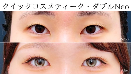 生まれつき一重にお悩みのお客様