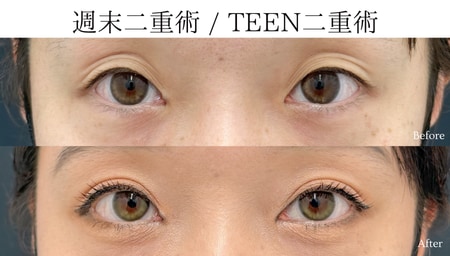 三重になっているまぶたのラインや左右差にお悩みのお客様