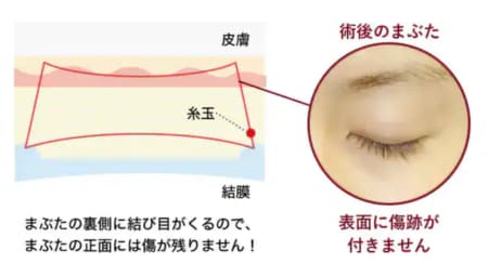 結び目が見えない！向山直樹院長限定の最高峰プラン