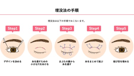 二重埋没法（切らない二重術）とは？当院の専門医が定義を解説