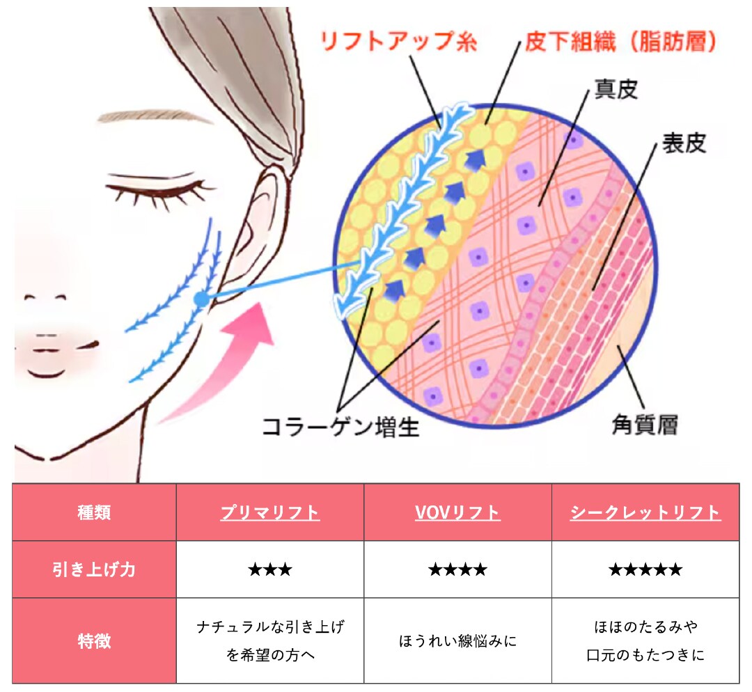 医師が解説する糸リフトの仕組みと効果