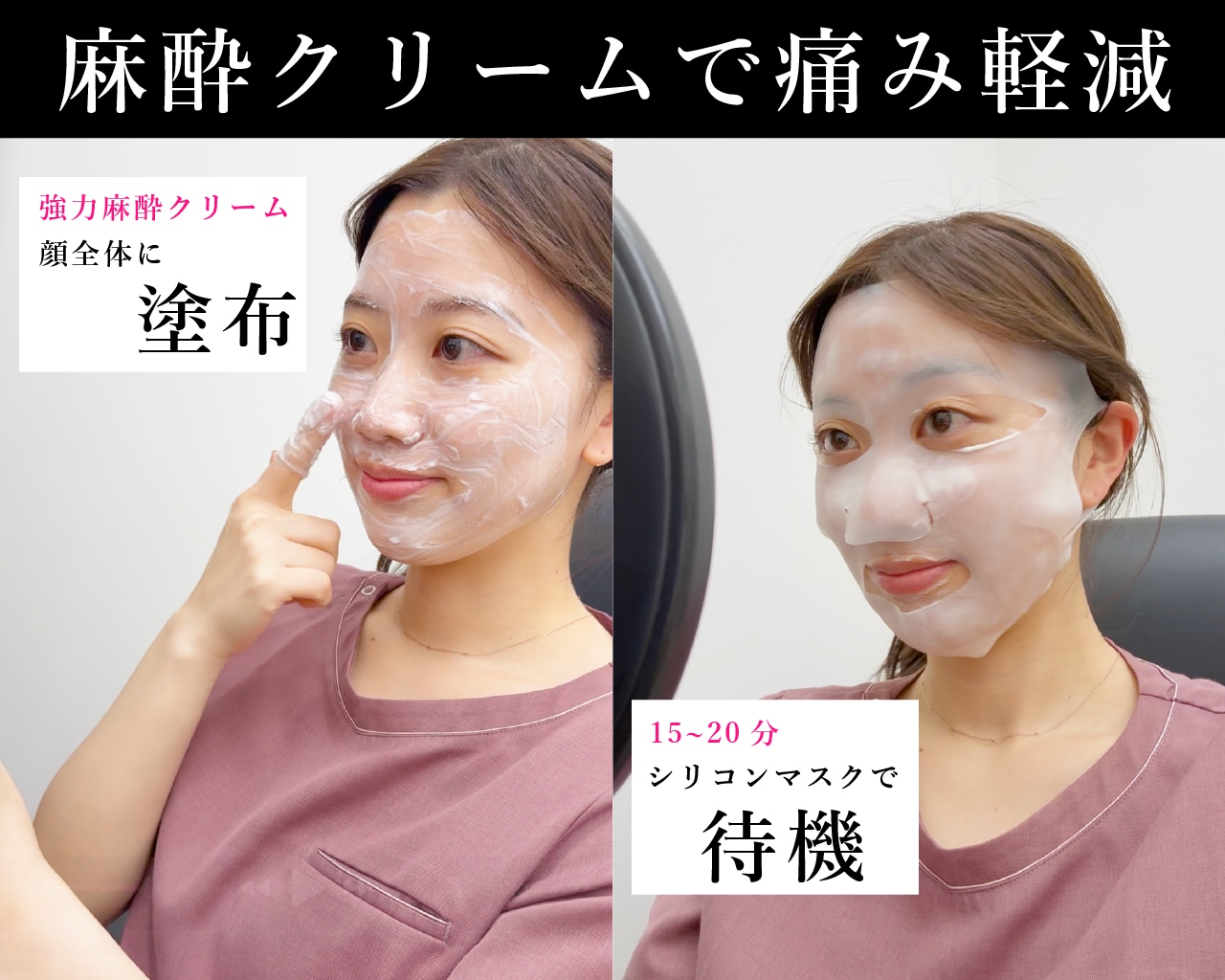 強力麻酔クリームで「ニードルRFの痛み」を克服