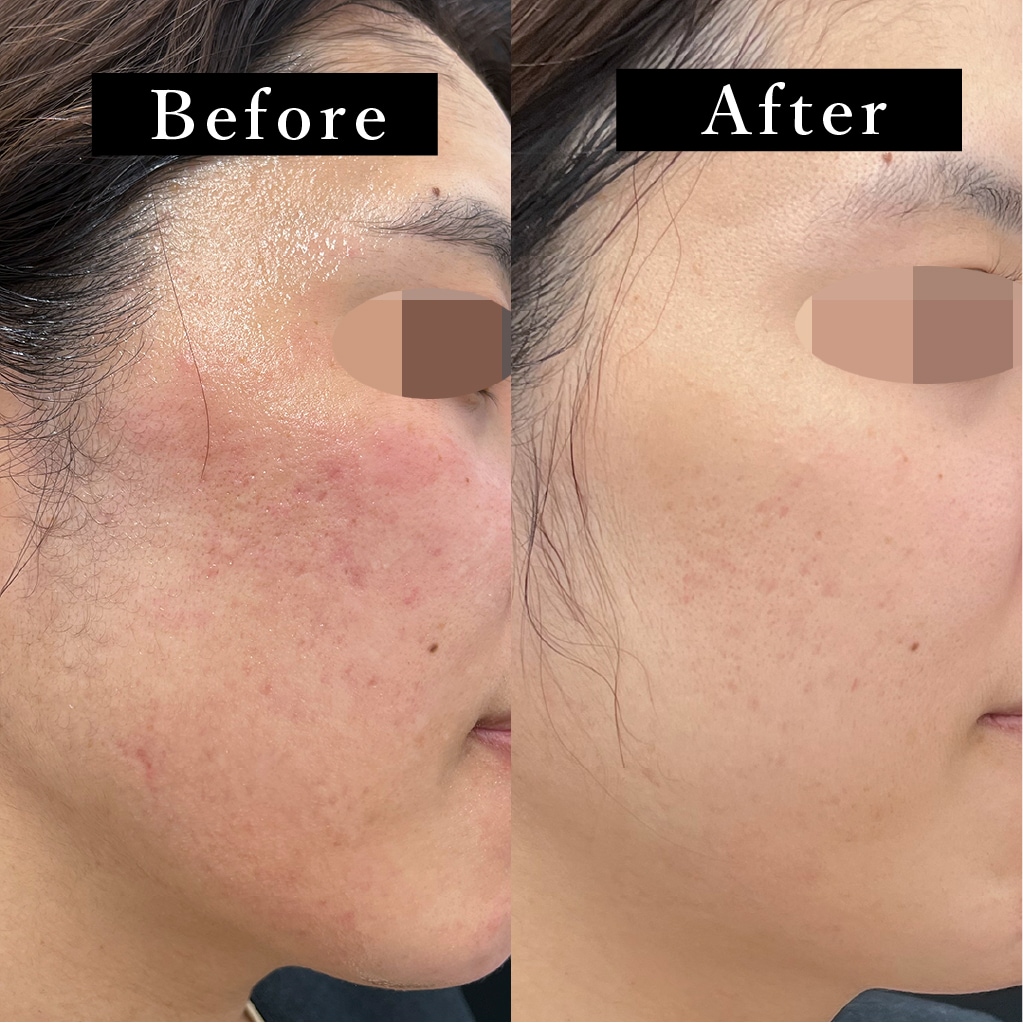 肝斑・毛穴・ニキビ跡へのアプローチ