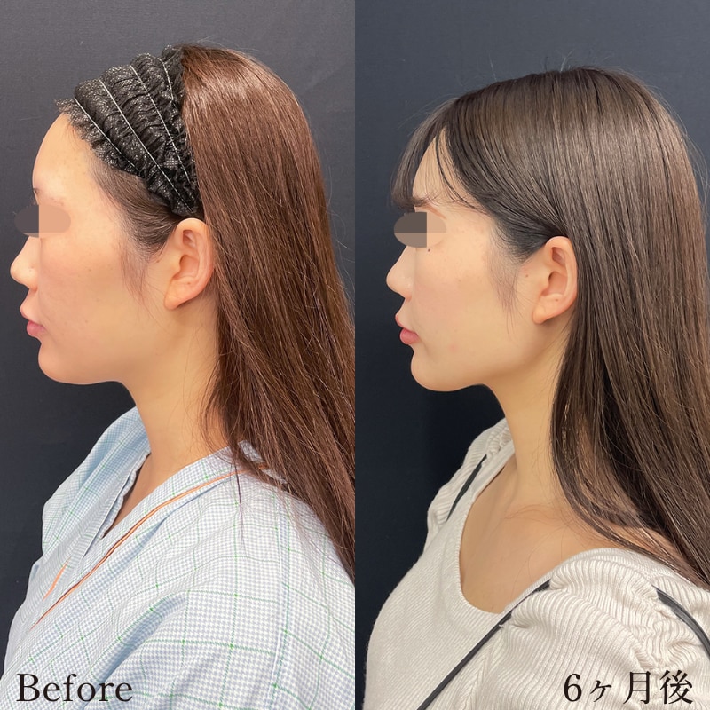 脂肪吸引イメージ1