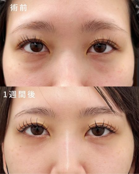 【20代女性】裏ハムラ
