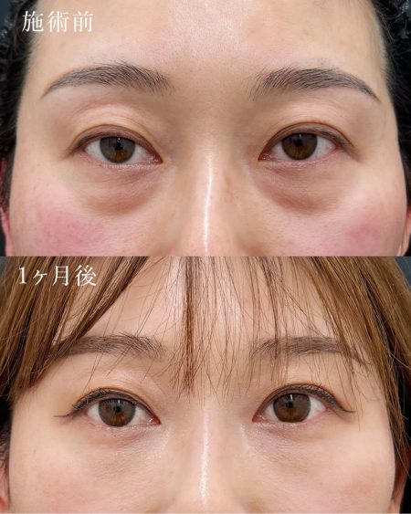 【30代女性】裏ハムラ × ナチュラル脂肪注射ナノリッチ（目の下）
