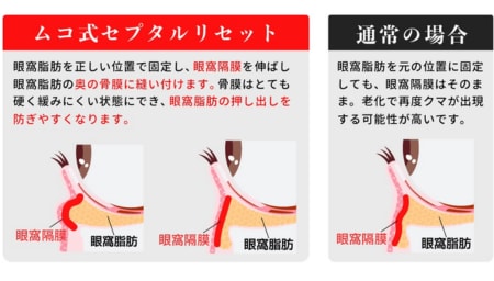 再発率を極限まで抑える独自技術「ムコ式裏ハムラ」