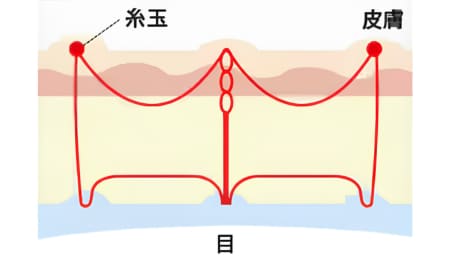 「フォーエバー二重術®」の術式解説