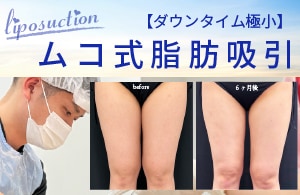 【ダウンタイム極小】ムコ式脂肪吸引