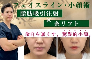 脂肪吸引注射×糸リフト
