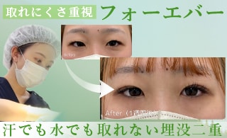 フォーエバー二重術