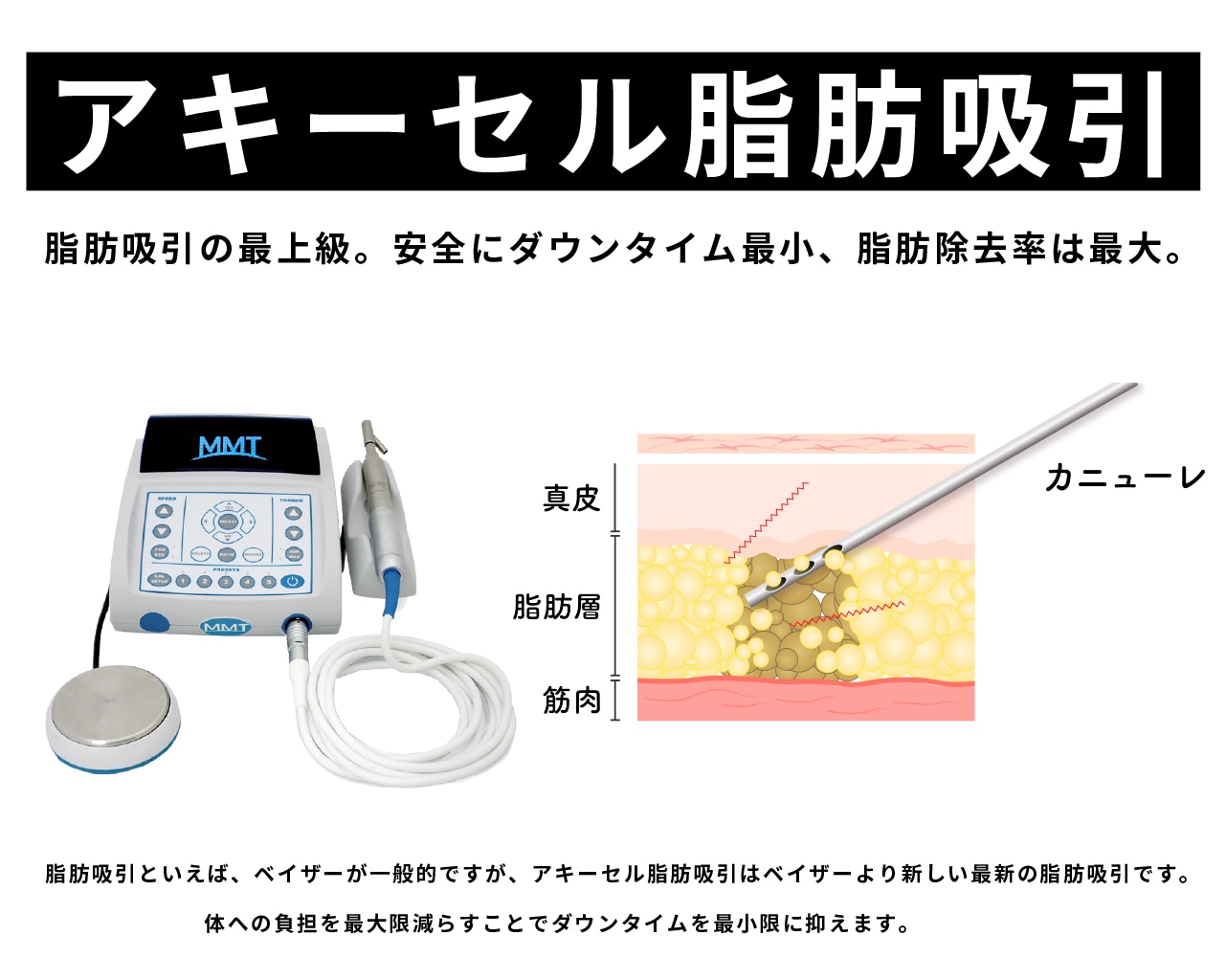 アキーセル脂肪吸引で組織へのダメージを最小限に