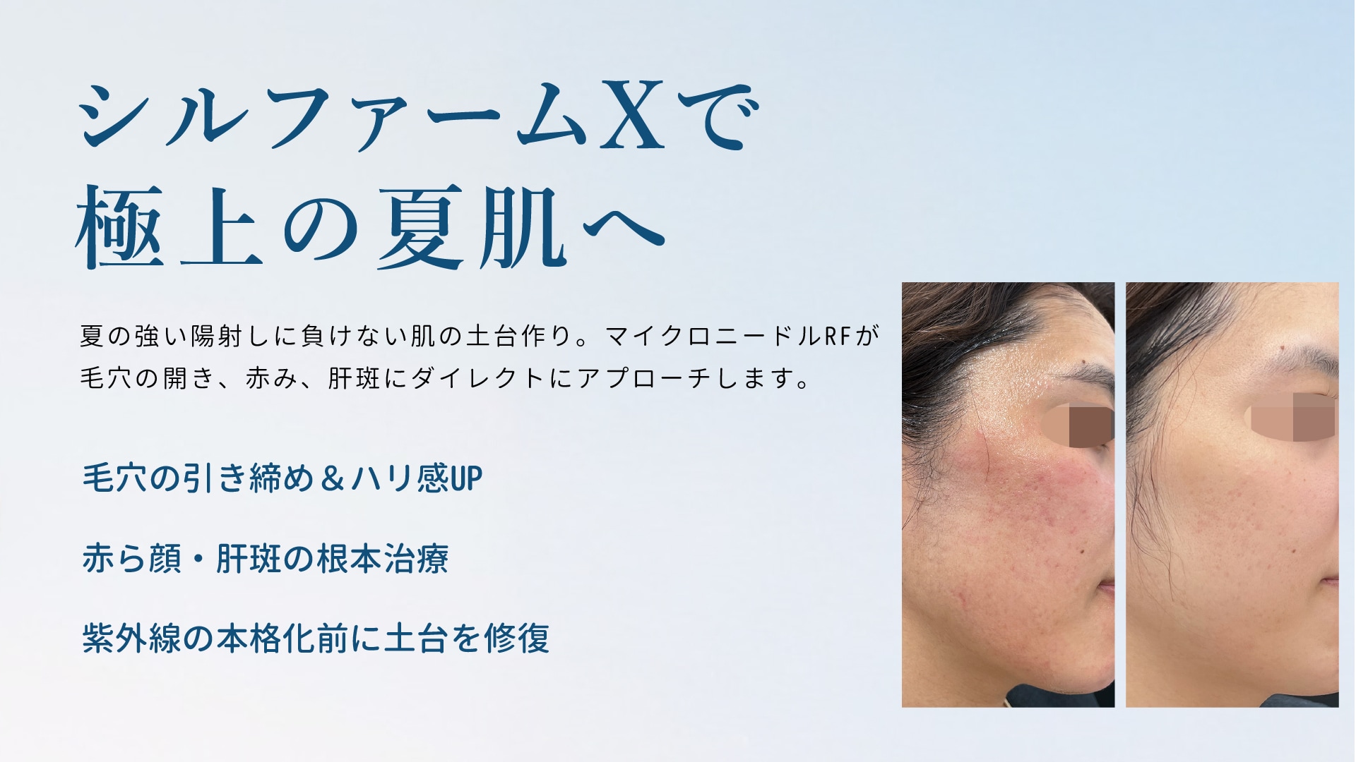 20代後半から40代の肌は、夏の紫外線や冷房によるインナードライで、毛穴の開きや赤みが目立ちやすくなります。<br />
ファンデーションがドロドロに崩れる前に仕込みたいのが、最新のマイクロニードルRF治療「シルファームX」です。