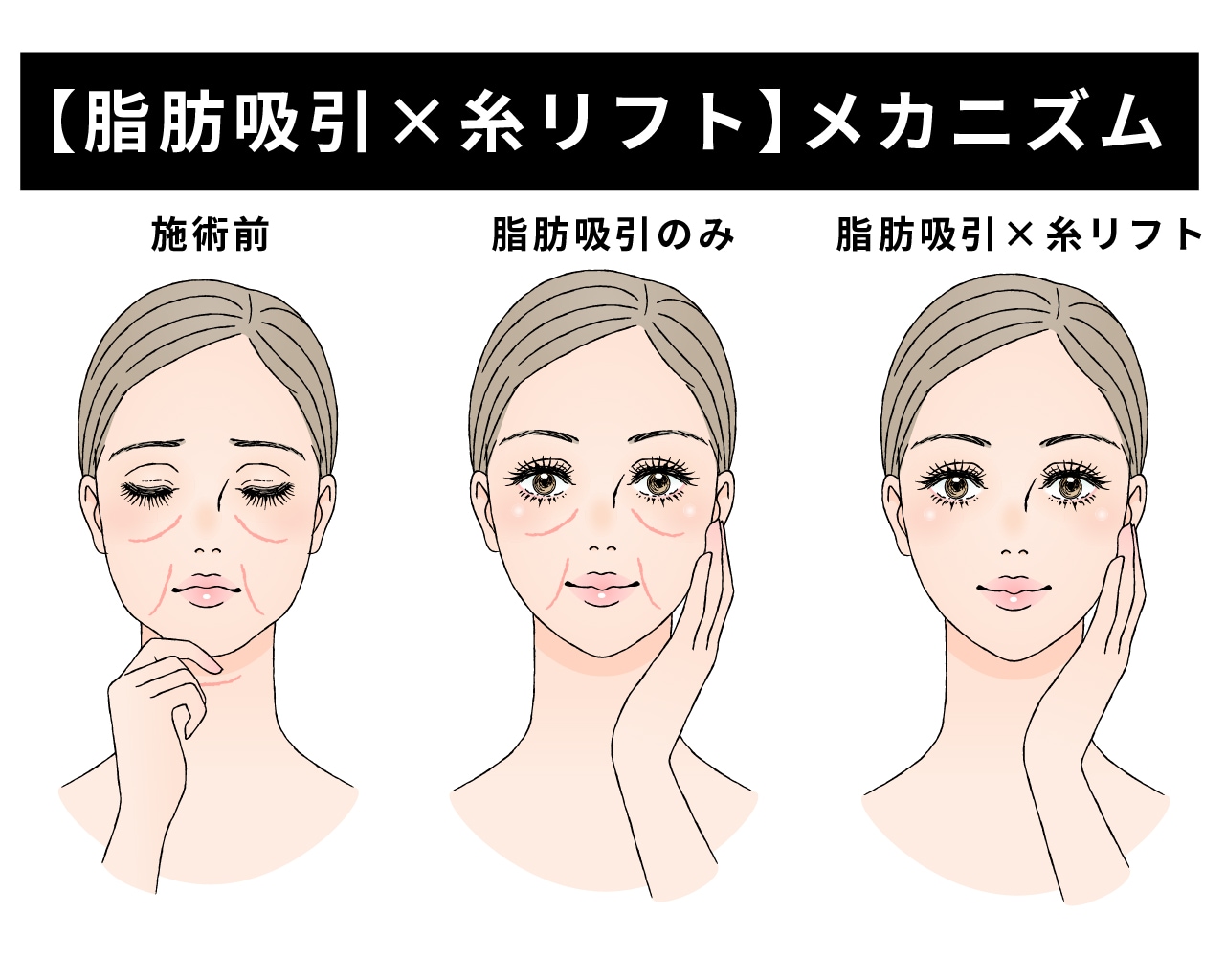 脂肪を取った後の「皮膚のたるみ」を即時に解決