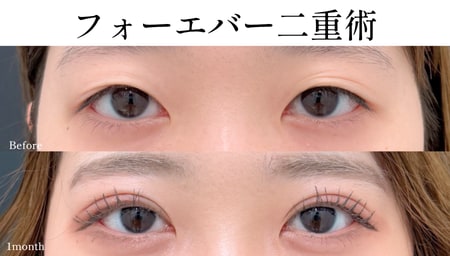 フォーエバー二重術
