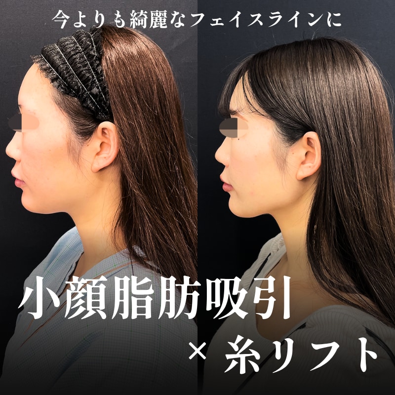 【関西/大阪】脂肪吸引をするなら症例数ランキング4冠達成の向山直樹院長で！夏までに小顔の脂肪吸引！スピード完成