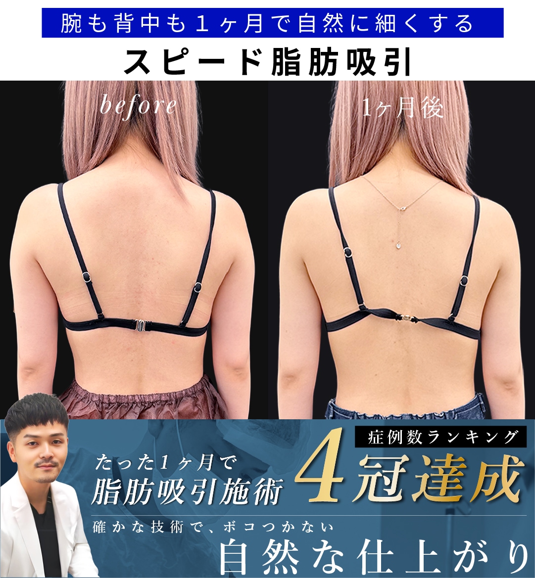 【大阪/脂肪吸引】20代女性の腕＆背中を１ヶ月で「自然」に細くする。二の腕スピード脂肪吸引
