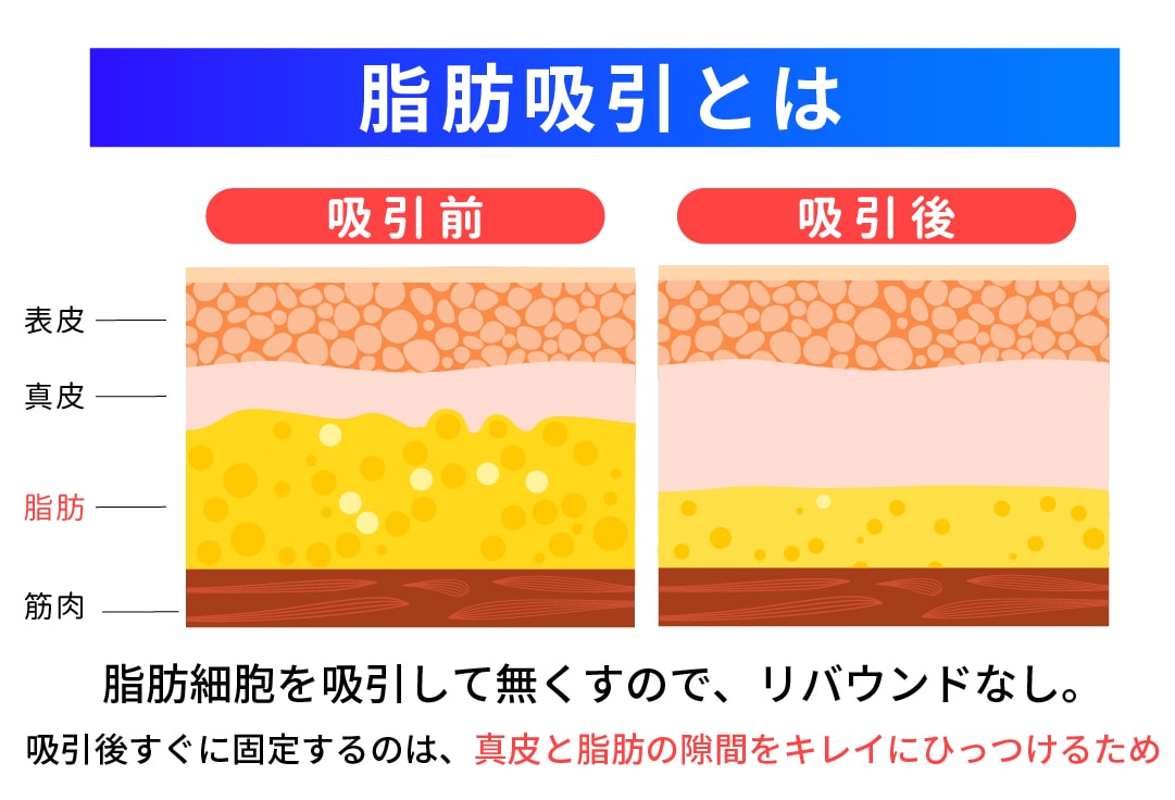 脂肪吸引の定義と痛みのメカニズム